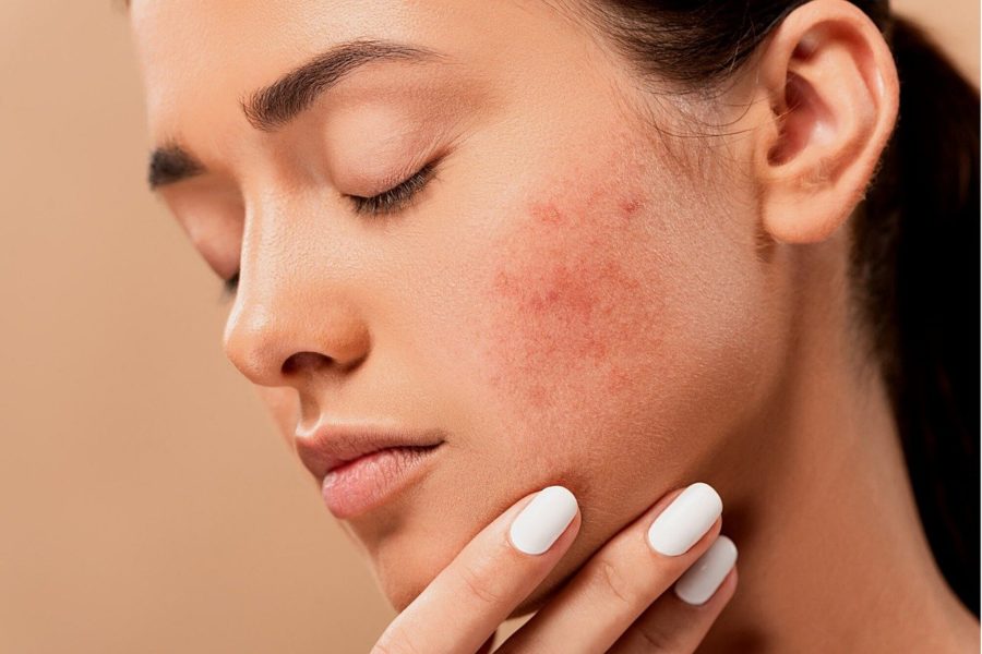 L’acné, comment s’en débarrasser ?